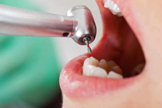 Best Emergency Tooth Extraction in Navarre, FL